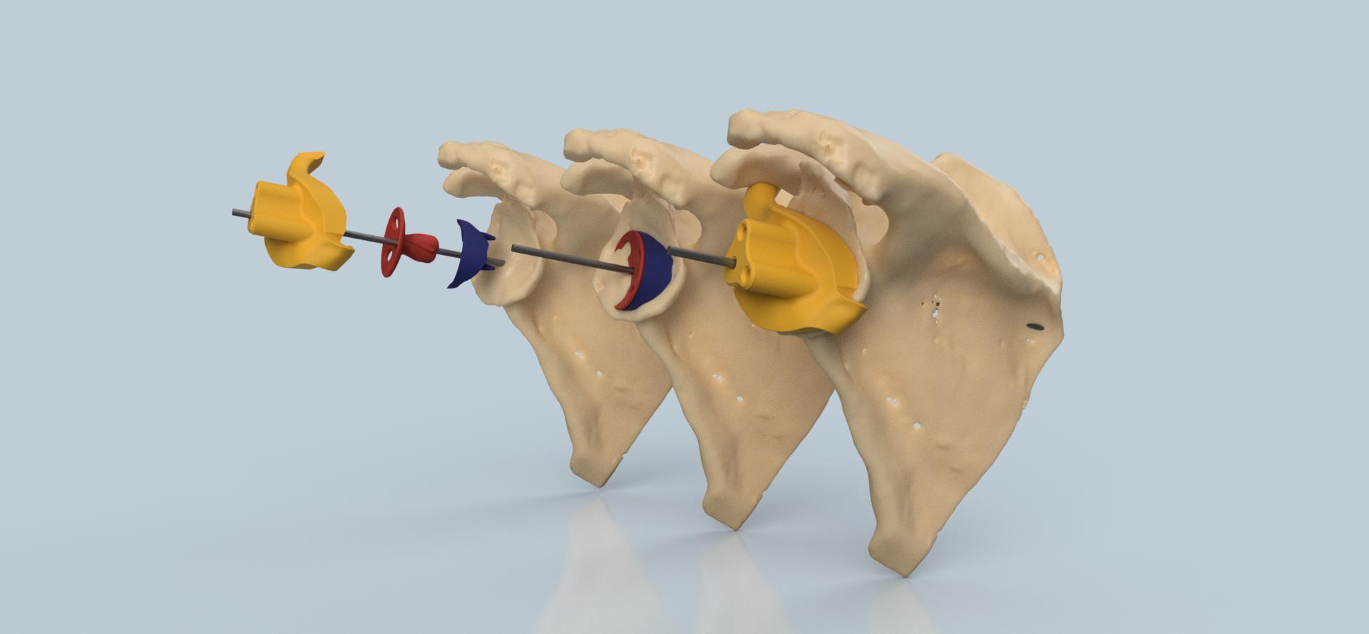 患者特定的肩部植入物