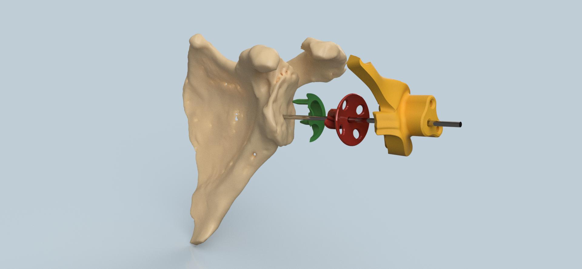 患者特定的肩部植入物
