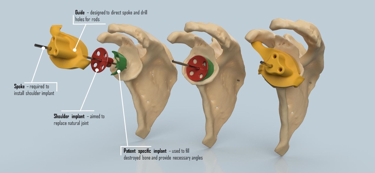 患者特定的肩部植入物