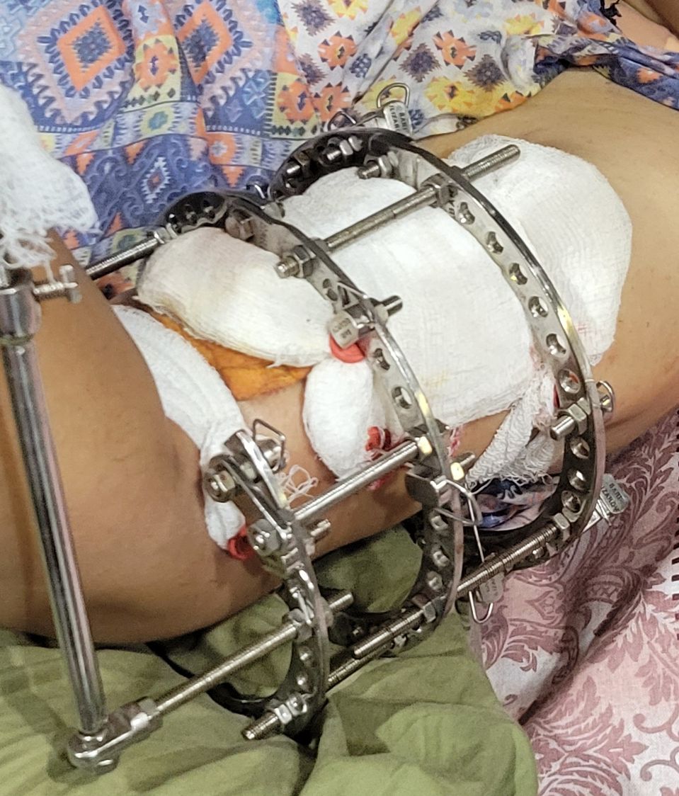 这种类型的框架用于治疗骨骼,它被称为“伊利扎洛夫技术”。该技术用于矫正先天性畸形骨、骨折和骨延长